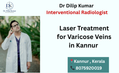 Laser Treatment for Varicose Veins