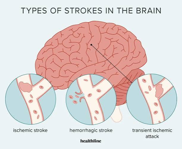 Brain Stroke Recovery